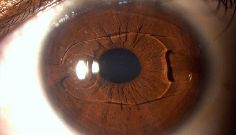 Realizan nuevo implante de retina con éxito en California
